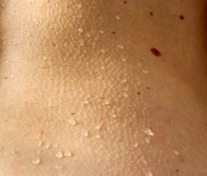 Dealing With Chicken Skin By The Oxford Beauty Clinic